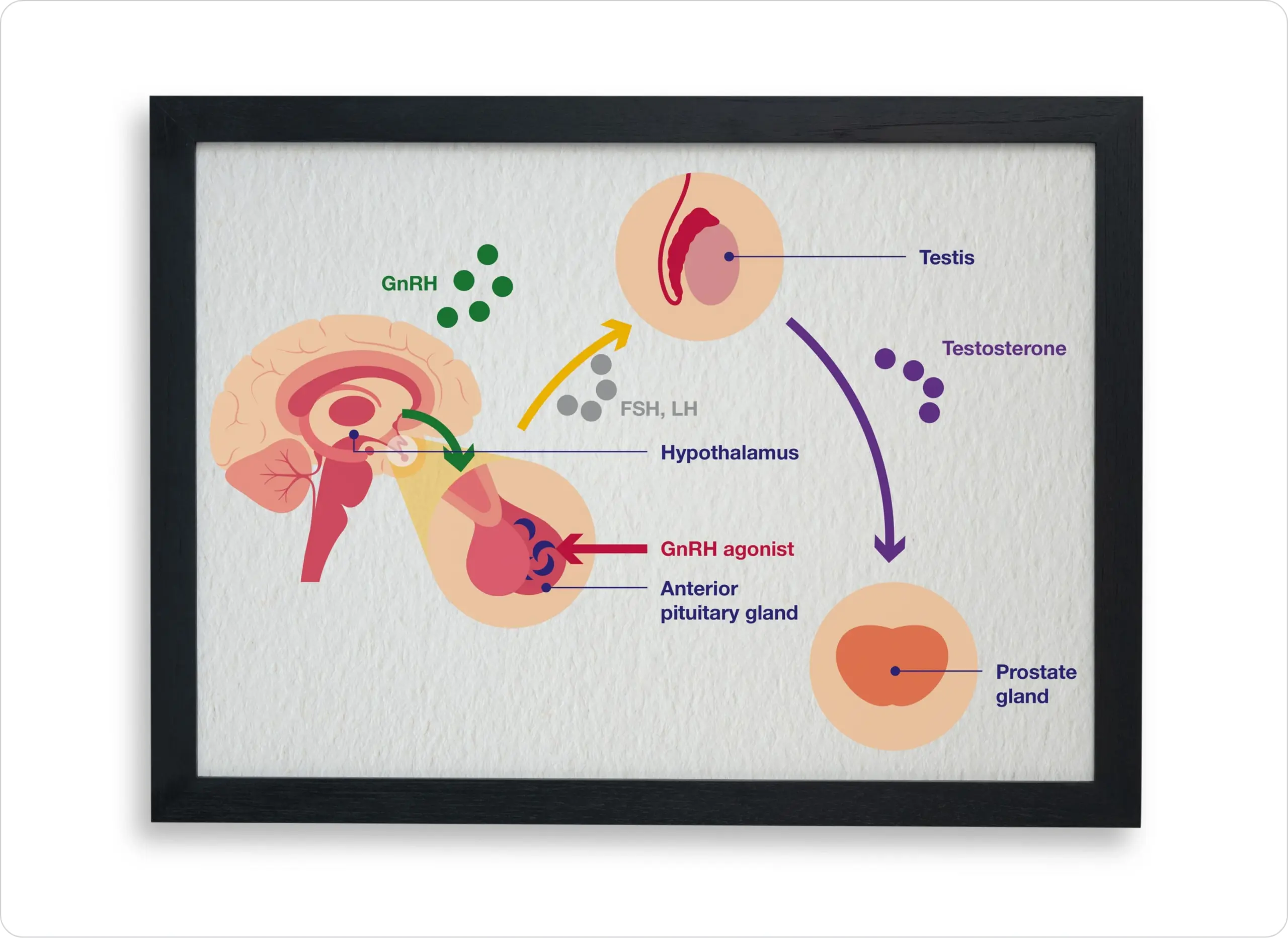 Oncology - Medical Education - GnRH agonists