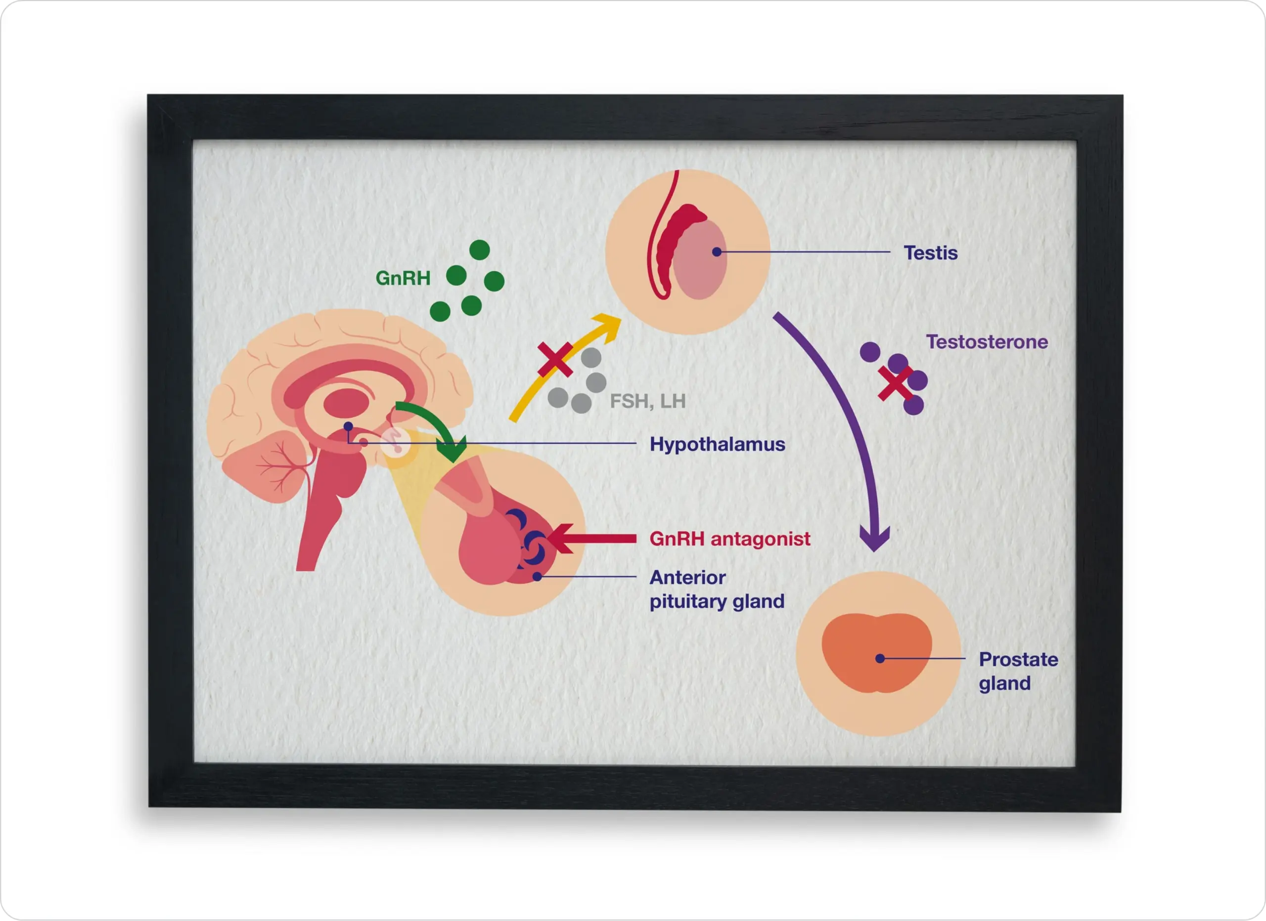 Oncology - Medical Education - GnRH antagonists
